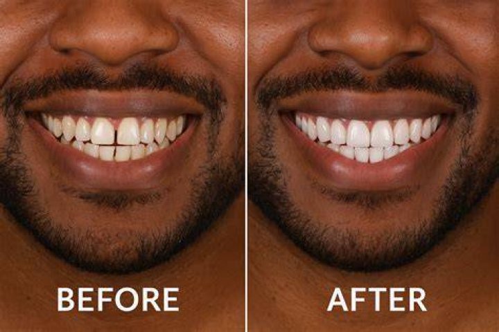 What Happened To Sha GZ Teeth | Before And After Photos